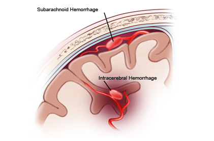 Joe Niekro Foundation - What is a Hemorrhagic Stroke?